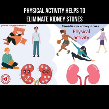 Physical activity helps to eliminate kidney stones