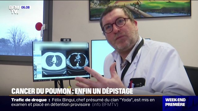 Cet hôpital sera l'un des premiers à participer à un projet de dépistage organisé du cancer du poumon