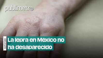 La lepra en México no ha desaparecido: Conoce son los estados con mayor número de casos