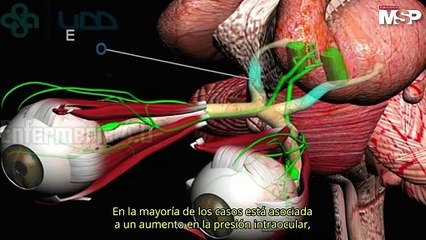 Glaucoma, Un riesgo hereditario al que debes prestar atención