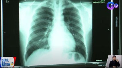 Influenza-induced pneumonia na sanhi ng pagkamatay ni Barbie Hsu, ipinaliwanag ng doktor | SONA