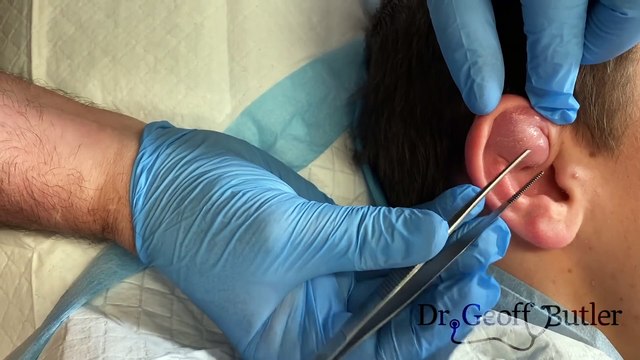 Effective Tips for Preventing Cauliflower Ear: Protect Your Ears with These Simple Strategies