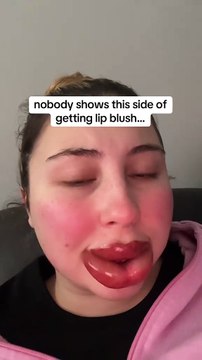 Cette femme a voulu avoir des lèvres parfaites et s’est transformée en « Boustiflor » !