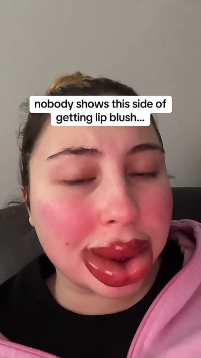 Cette femme a voulu avoir des lèvres parfaites et s’est transformée en « Boustiflor » !