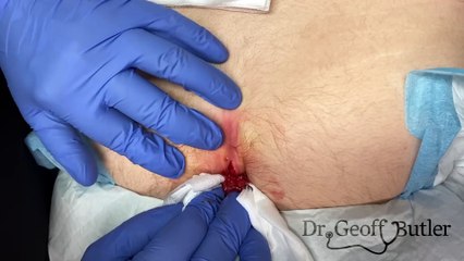 Effective Drainage Techniques for an Infected Pilonidal Cyst: A Step-by-Step Guide