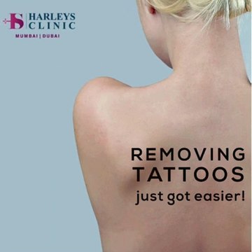 Safe & Effective Laser Tattoo Removal in Mumbai