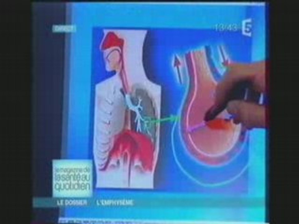 Emphyseme