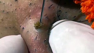 Professional Blackhead Treatment at a Beauty Clinic: ASMR Experience!