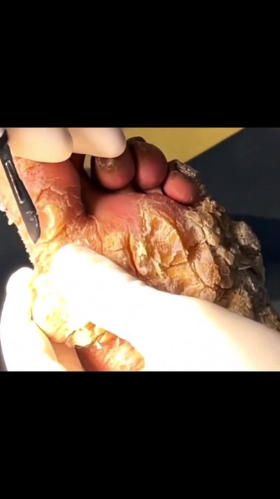 Sac Dep Spa ASMR Facial: Say Goodbye to Stubborn Blackheads!