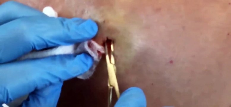 Acne Therapist Reveals Blackhead Extraction Secrets (ASMR Triggers)