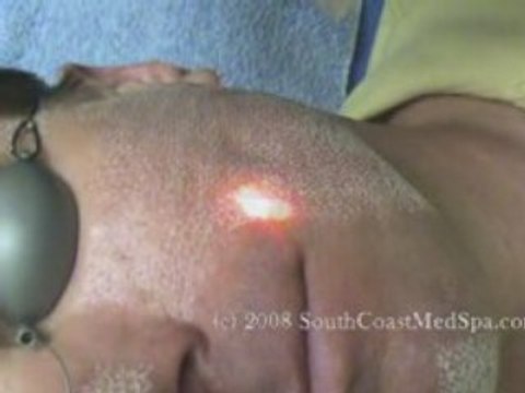 Active FX Laser Acne Scar Removal