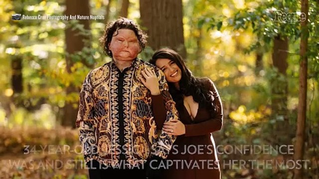 After Receiving Face of 47-Year-Old Donor During Transplant, Man 22, Falls in Love with Nurse. How It Started with 1 DM (Exclusive)