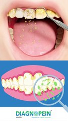 Double the Shine, One Amazing Deal – Buy 1 Dental Scaling, Get 1 Free!