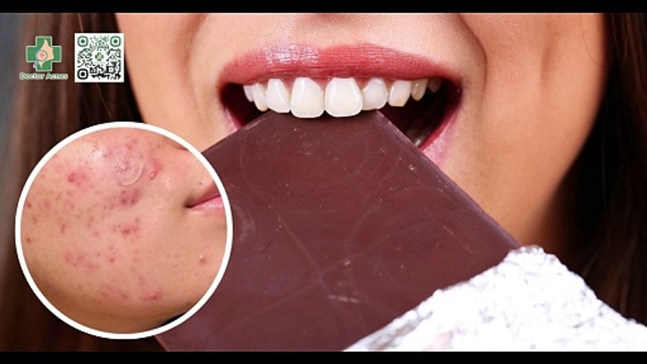 Ăn socola có nổi mụn không? Cách ăn socola không ảnh hưởng đến da