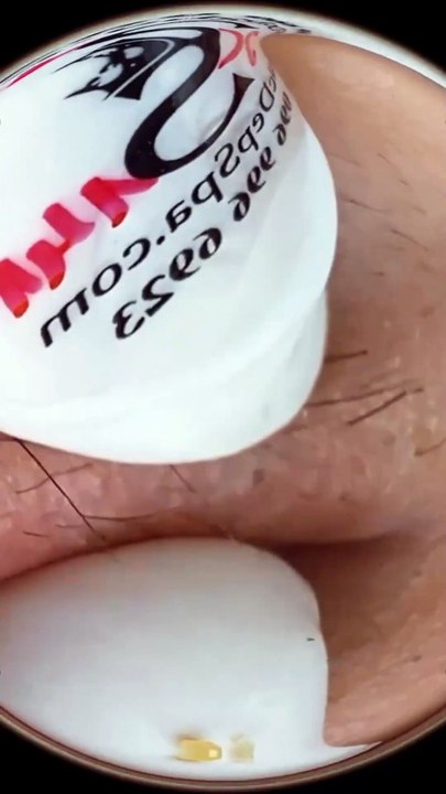 SATISFYING BLACKHEADS COMPILATION,  Clearing the Way Effective Blackhead Removal Techniques (21)