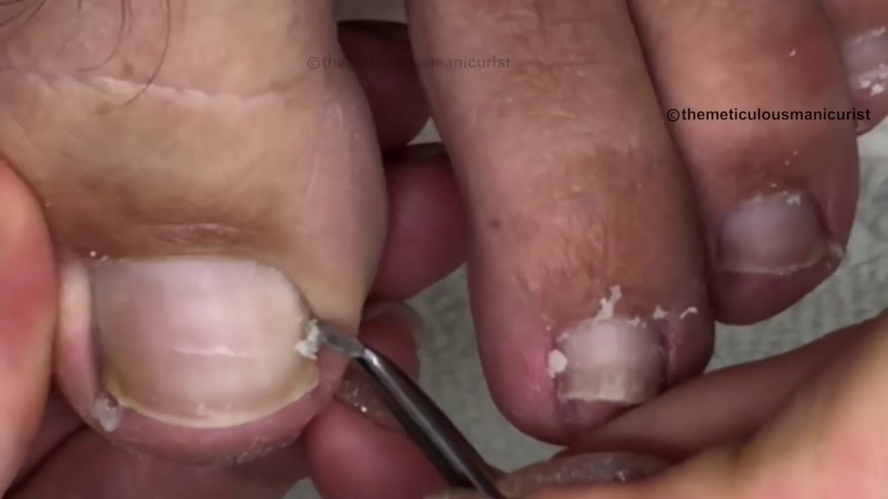 How to Clean Impacted Toenail Satisfying Pedicure Tutorial 👣