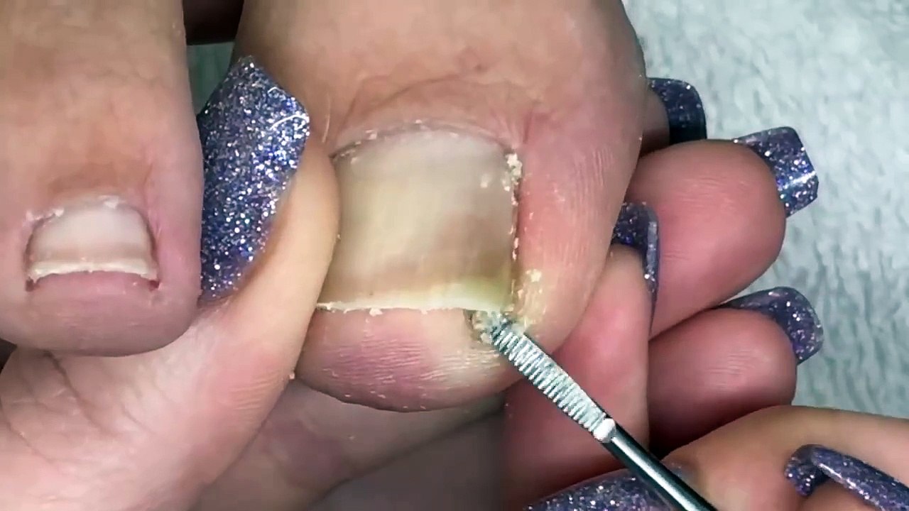 Before You Remove Your Big Teonail Watch This: Impacted or Ingrown Toenail Pedicure Tutorial 👣
