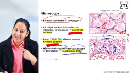 2. Hyperemia and Congestion,CVC Lung, CVC Liver, CVC Spleen