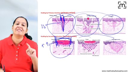 2. Healing by 1°&2°Intention