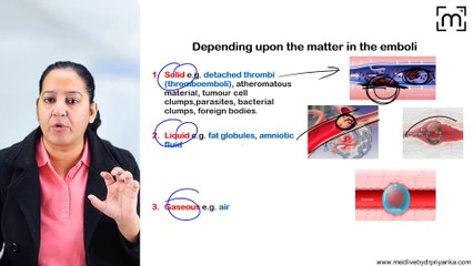 4. Embolism