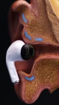 Your Earbuds Could Be Causing Ear Infections! Here’s Why 🦠👂#infection #earbuds