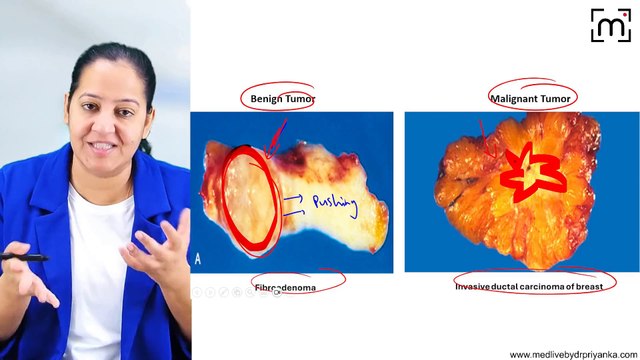 3. Benign versus Malignant Tumours