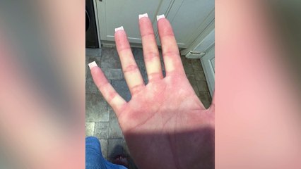 "I'm allergic to water - showers are excruciating and I can't go out in the rain"