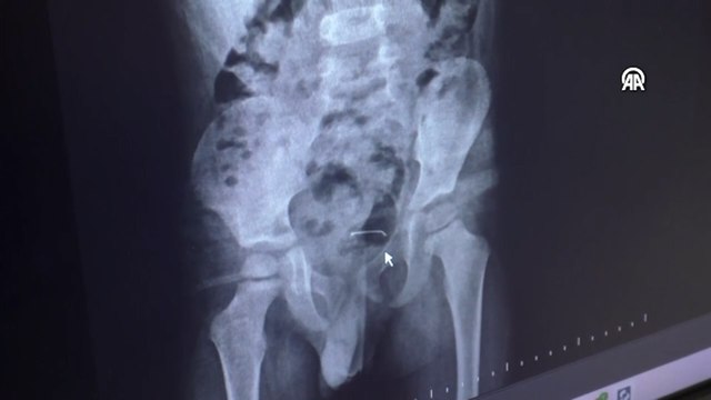 Bitlis'te 5 yaşındaki çocuğun yuttuğu toplu iğne ameliyatla çıkarıldı