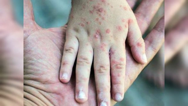 OMS revela otra posible vía de contagio de la viruela símica