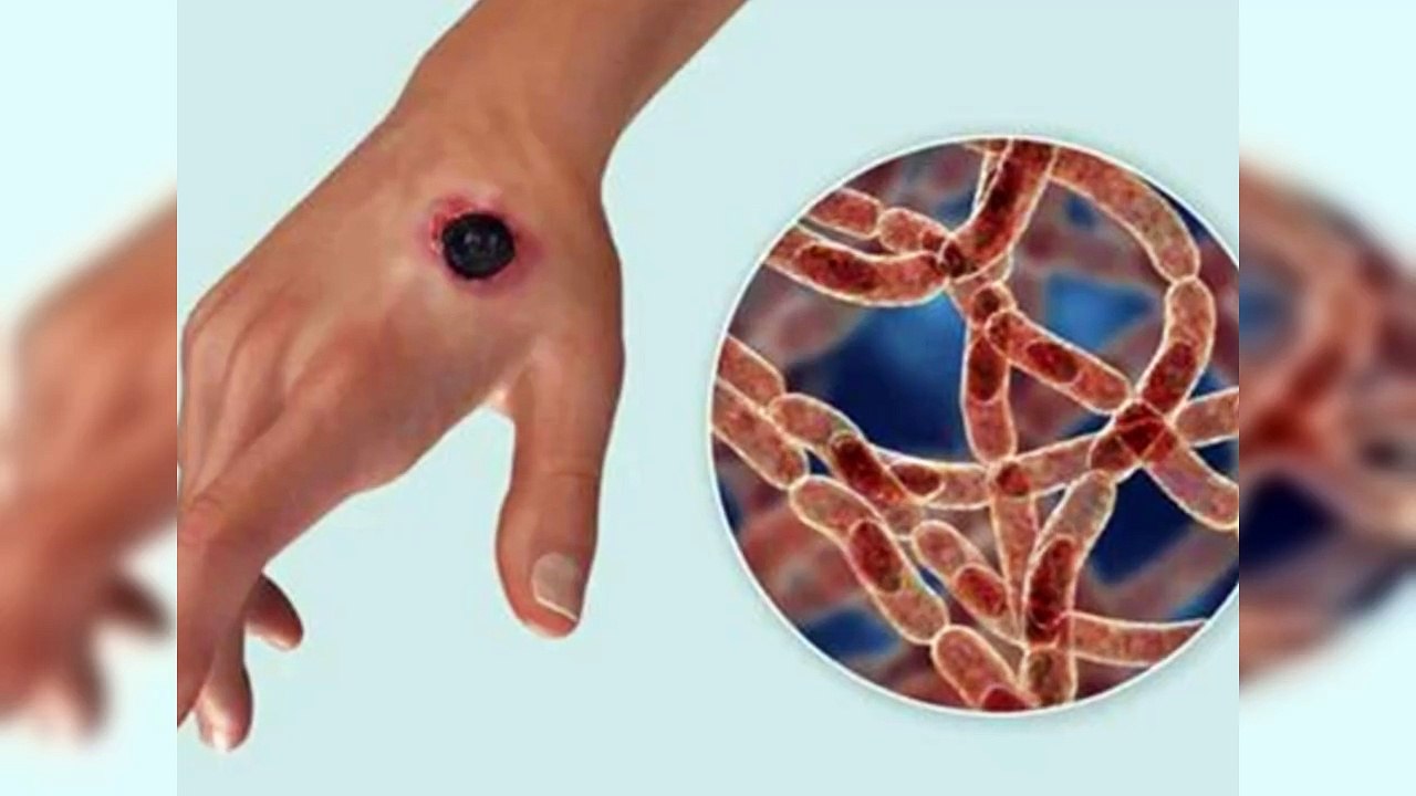 Tratamiento con antibióticos contra ántrax es sencillo