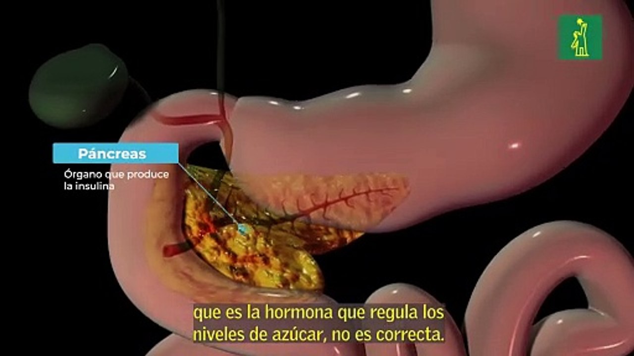 Día Mundial de la Diabetes: ¿Cuál es la diferencia entre la diabetes tipo 1 y la tipo 2?