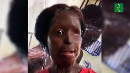 Víctimas de ácido del diablo convocan a concentración frente al Congreso Nacional