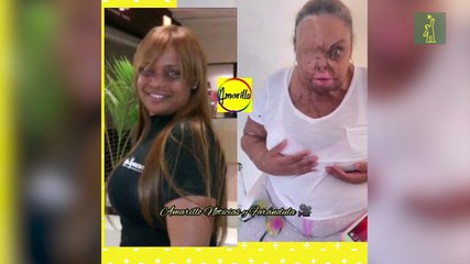 Víctima de ácido del diablo solicita ayuda al Gobierno para cirugía