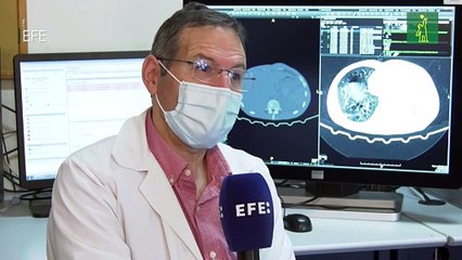 Un modelo arterial 3D 'a la carta' para ensayar operaciones de aneurisma cerebral