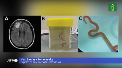 Médicos australianos hallan por primera vez lombriz parásita en cerebro de mujer