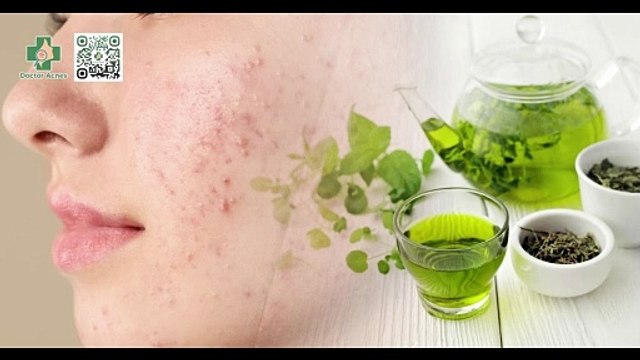 Uống nước trà xanh có trị mụn không? Cách dùng trà xanh trị mụn
