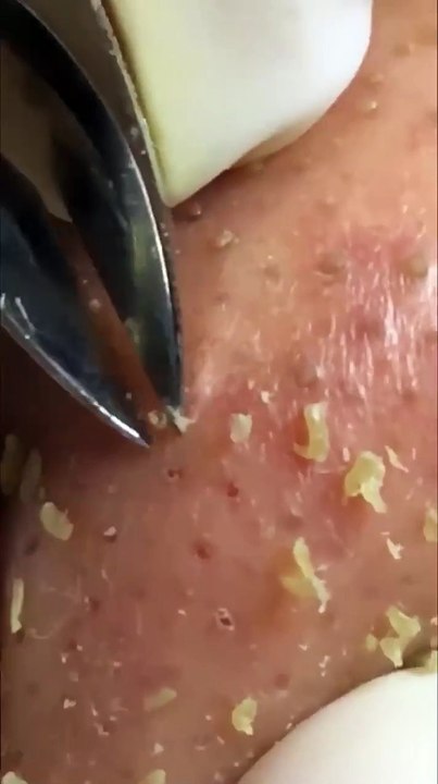 Professional Acne Treatment: Rediscover Your Skin!