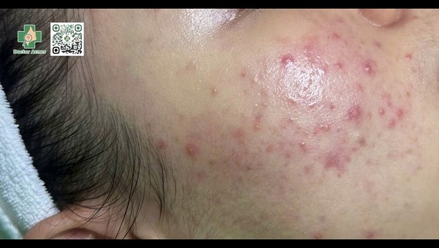 Mụn trứng cá có tự hết không? Cách điều trị an toàn và hiệu quả