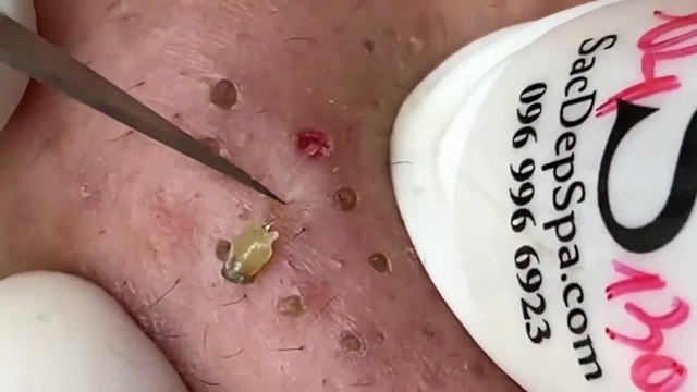 Sacdepspa Facial Treatment: Blackhead Removal, Acne Therapy & Skin Rejuvenation