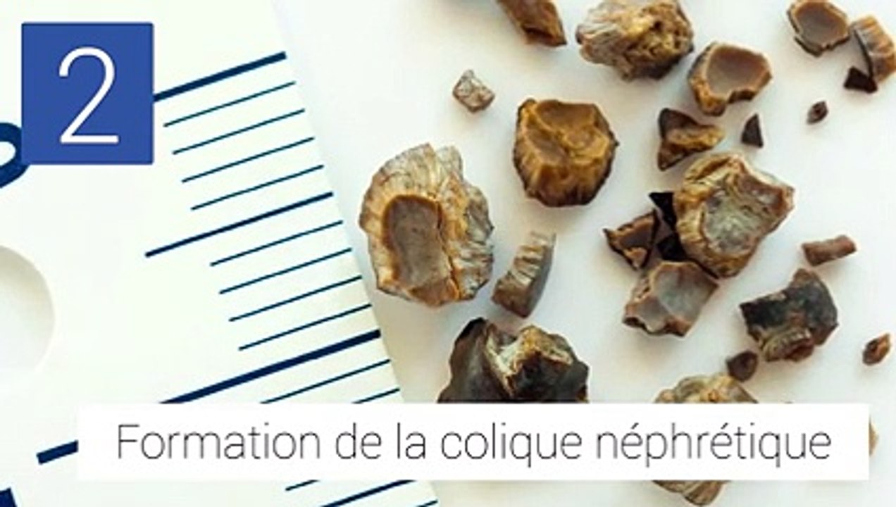 Les traitements médicaux des calculs rénaux