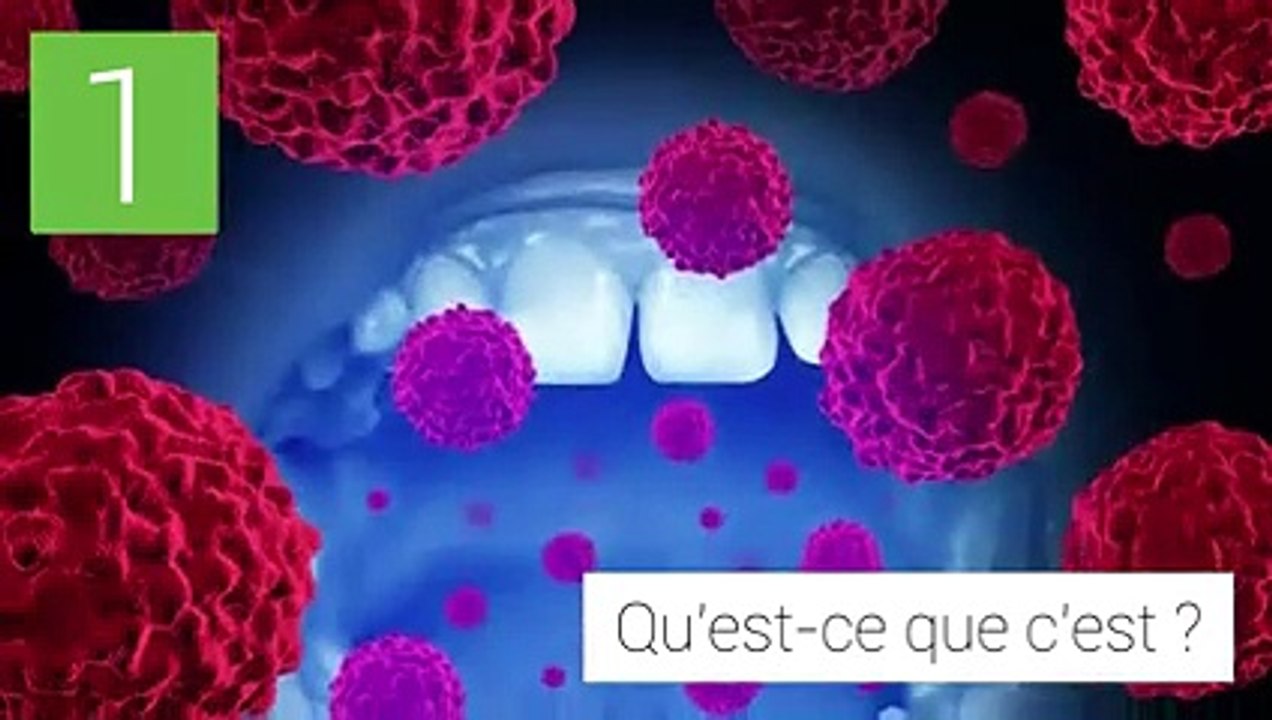 Cancer de la gorge : reconnaître les symptômes