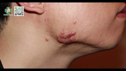 Sẹo lồi ngứa khó chịu: nguyên nhân và cách điều trị hiệu quả