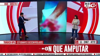 Tragedia en UPD: tuvieron que amputarle la mano a un estudinte