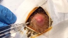 MEGA CYST REMOVAL,  The Mysterious Cyst The Story of an Extraordinary Removal!