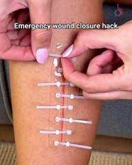 Close wounds fast without medical tools