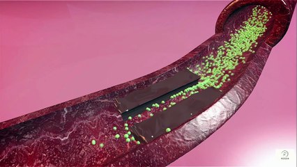 What Is Hyperlipidemia Explained Simply for Seniors- Easy Cholesterol -Triglyceride Breakdown