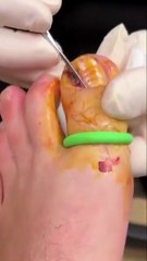 How to remove an ingrown toenail!😳😫 (not medical advice)