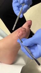 How to Remove Sutures (NOT MEDICAL ADVICE!)