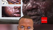 Variole du singe | 25 contacts du malade, entré au Sénégal, recensés et mis sous surveillance