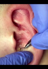 Points Noirs sur le Nez : Mes Astuces Miracles !